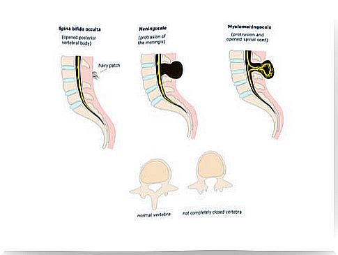 Spina bifida is a neural tube defect.