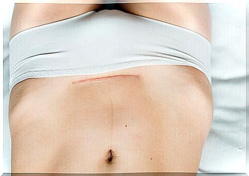 Caesarean scar