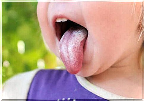 Oral candidiasis in children