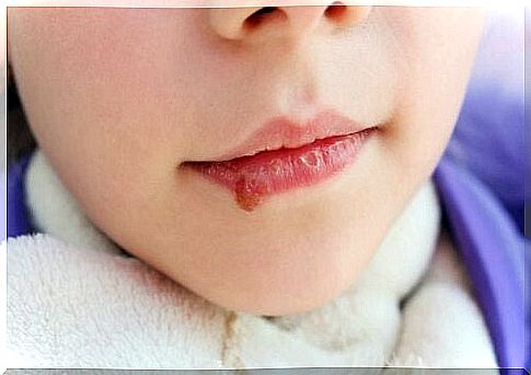 Oral candidiasis on the lip of a child.