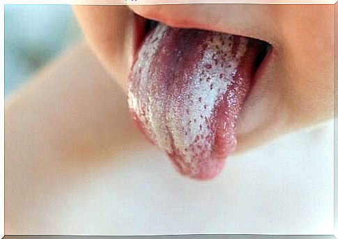 A child with oral thrush.